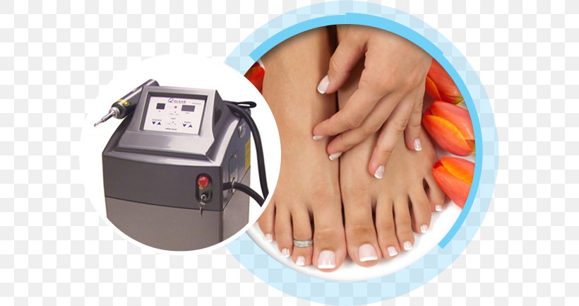 Toe Ring Foot Nail Onychomycosis, PNG, 595x433px, Toe Ring, Ankle, Digit, Finger, Flat Feet Download Free