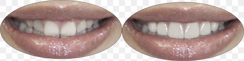 Crown Lengthening Veneer Dentistry Mouth, PNG, 2328x585px, Watercolor, Cartoon, Flower, Frame, Heart Download Free
