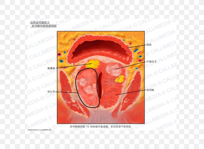 Prostate Anatomy Urinary Bladder Magnetic Resonance Imaging Hypertrophy, PNG, 600x600px, Watercolor, Cartoon, Flower, Frame, Heart Download Free