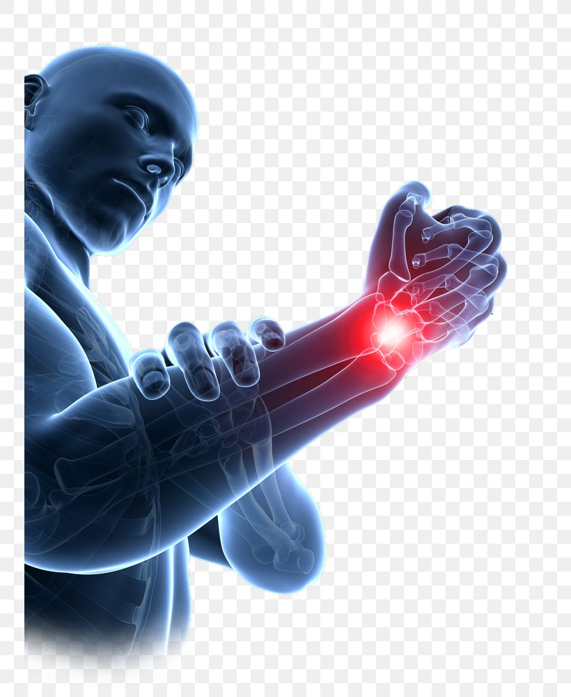 Repetitive Strain Injury Carpal Tunnel Syndrome Wrist Carpal Bones, PNG, 750x1000px, Repetitive Strain Injury, Carpal Bones, Carpal Tunnel, Carpal Tunnel Syndrome, Hand Download Free