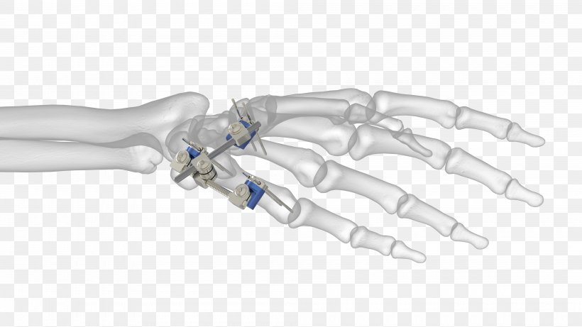 Thumb Ortho-aktiv Medizintechnik GmbH External Fixation Distal Radius Fracture Bone, PNG, 4000x2250px, Thumb, Arm, Bone, Bone Fracture, Distal Download Free