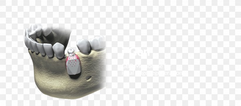 Implant Stability Quotient Dental Implant Product Thor Shoe, PNG, 2500x1100px, Dental Implant, Shoe, Thor, Thor Ragnarok Download Free