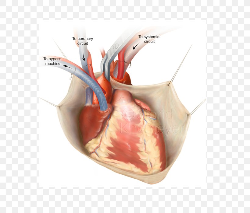 Coronary Artery Bypass Surgery Vascular Bypass Off-pump Coronary Artery Bypass Coronary Artery Disease, PNG, 700x700px, Watercolor, Cartoon, Flower, Frame, Heart Download Free