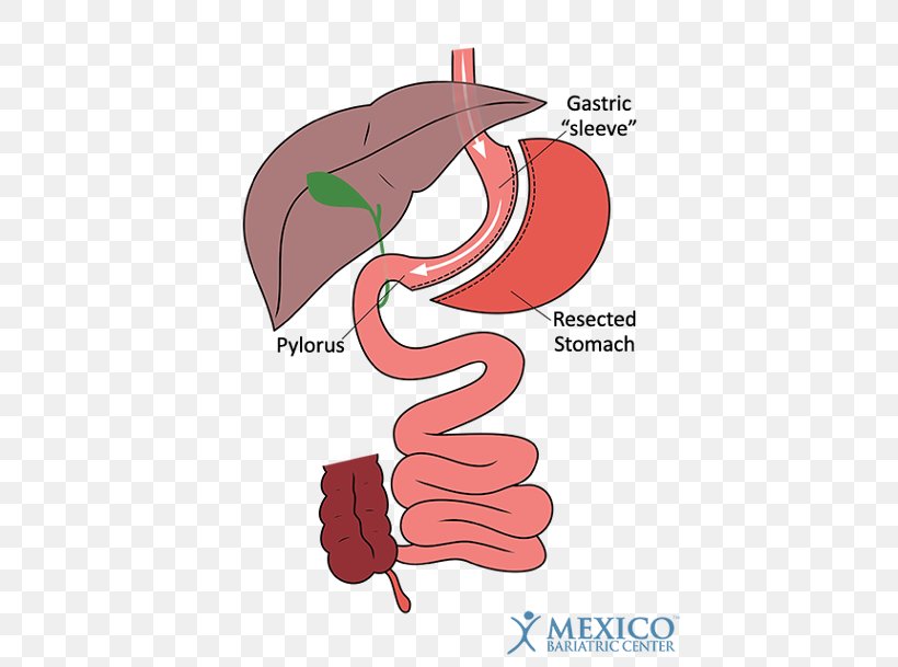 Duodenal Switch Bariatric Surgery Gastric Bypass Surgery Sleeve Gastrectomy, PNG, 428x609px, Watercolor, Cartoon, Flower, Frame, Heart Download Free