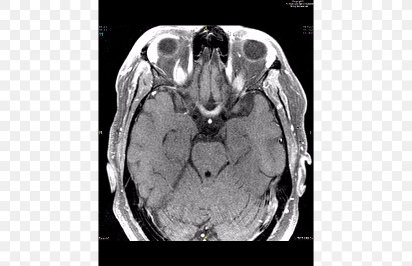 Neuromyelitis Optica Spinal Cord Magnetic Resonance Imaging Neurology White Matter, PNG, 580x529px, Watercolor, Cartoon, Flower, Frame, Heart Download Free