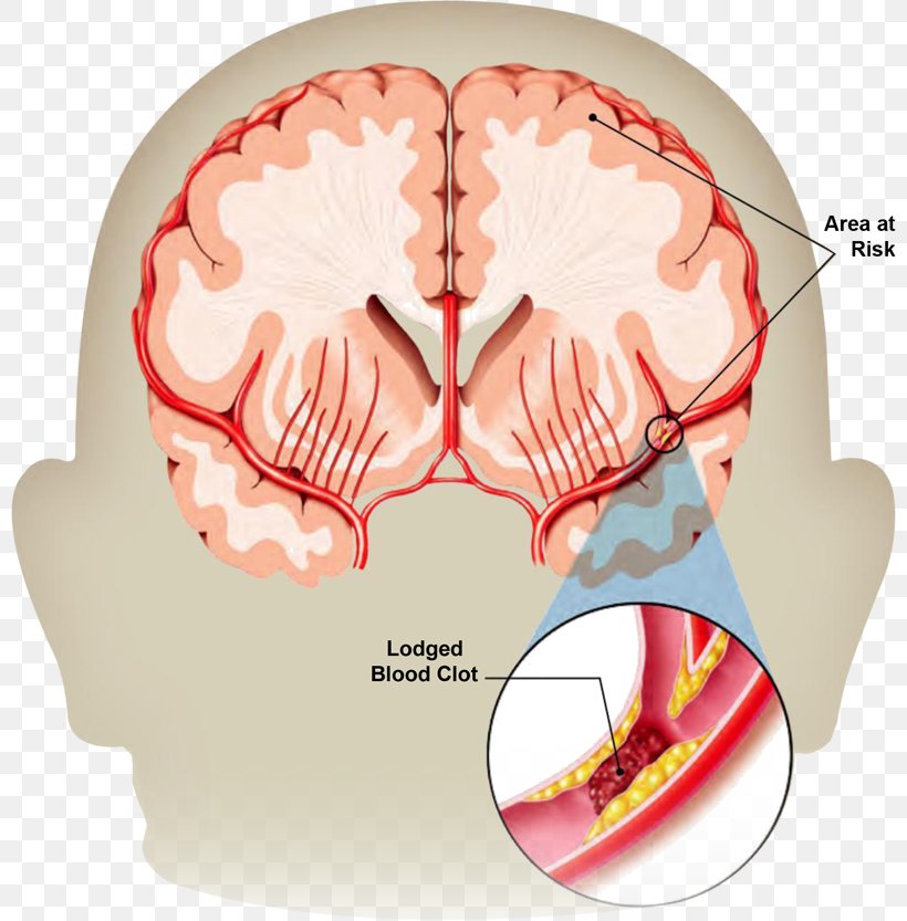 Stroke Transient Ischemic Attack Neurology Brain Haemorrhage Health, PNG, 800x833px, Watercolor, Cartoon, Flower, Frame, Heart Download Free