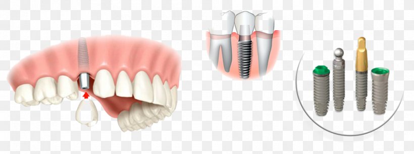 Dental Implant Dentistry Tooth Implantology, PNG, 938x351px, Dental Implant, Body Jewelry, Crown, Dental Laboratory, Dentistry Download Free