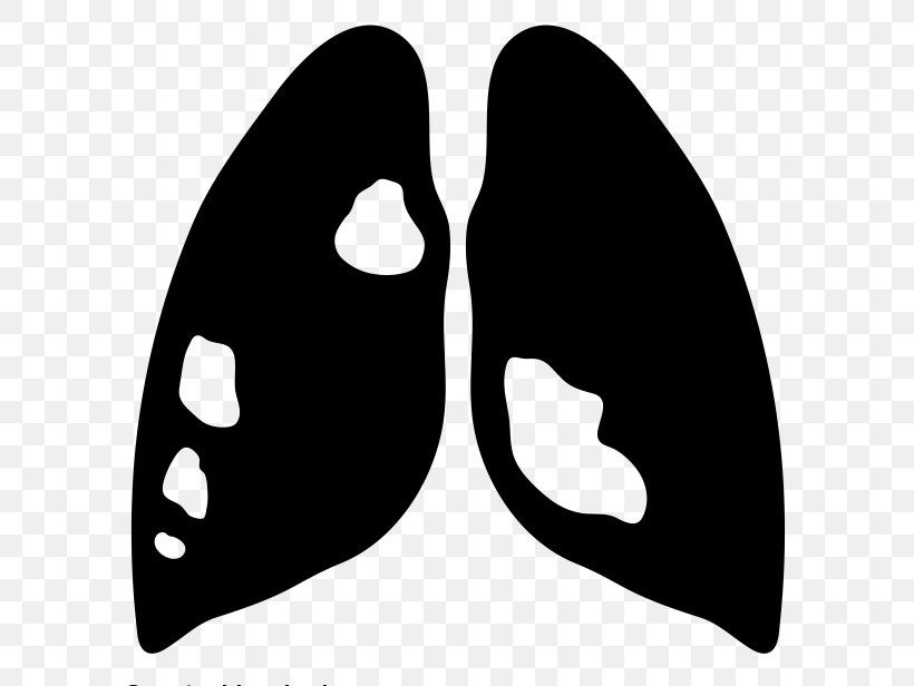 Lung Cancer Lung Cancer Respiratory Disease, PNG, 700x616px, Lung, Air Pollution, Black, Black And White, Cancer Download Free