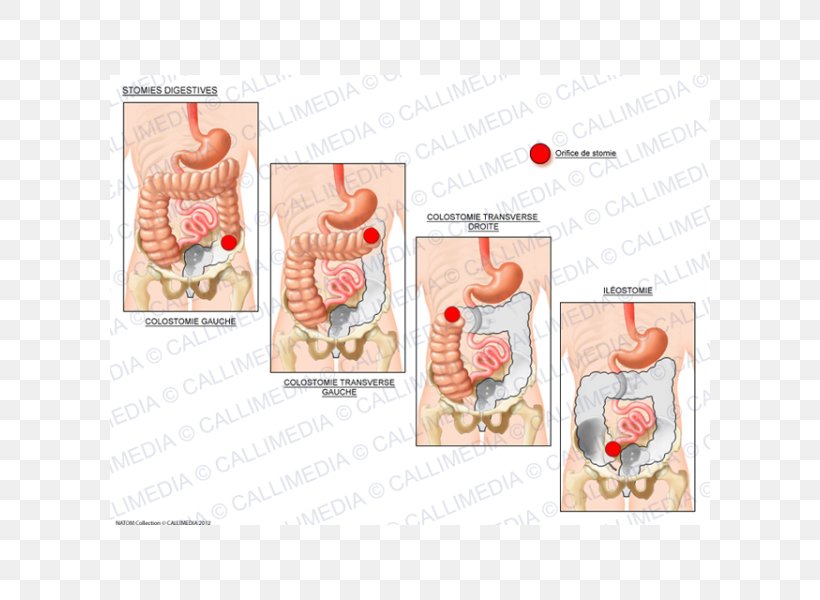 Stoma Ileostomy Ostomía Digestion Colostomy, PNG, 600x600px, Watercolor, Cartoon, Flower, Frame, Heart Download Free