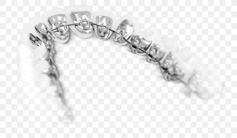 Lingual Braces Dental Braces Orthodontics Tongue Tooth, PNG, 1378x801px, Lingual Braces, Black And White, Body Jewelry, Bracelet, Chain Download Free