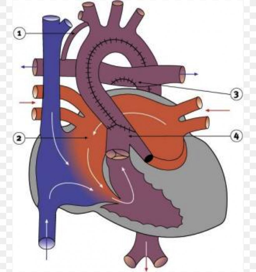 Coarctation Of The Aorta Ductus Arteriosus Congenital Heart Defect ...