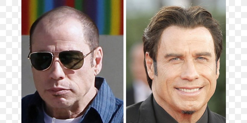 John Travolta John Cleese Hair Transplantation Hair Loss Celebrity, PNG, 810x410px, John Travolta, Actor, Celebrity, Chin, Cosmetics Download Free