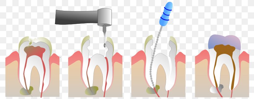 Endodontic Therapy Root Canal Pulp Endodontics Dentistry, PNG, 800x320px, Endodontic Therapy, Brush, Cutlery, Dental Extraction, Dental Restoration Download Free
