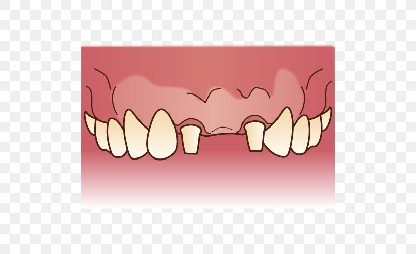 Tooth Dentures Dentist 歯科 Bridge, PNG, 500x500px, Watercolor, Cartoon, Flower, Frame, Heart Download Free