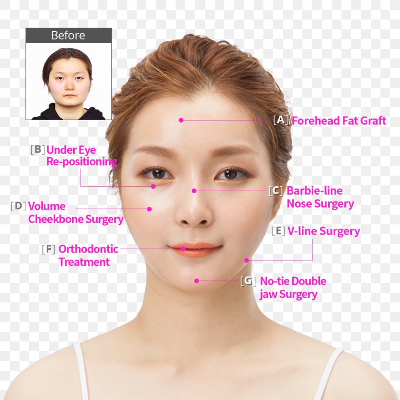 Kim Ji Hyun 美容外科学 South Korea Surgery Hospital, PNG, 1110x1110px, South Korea, Beauty, Cheek, Chin, Ear Download Free