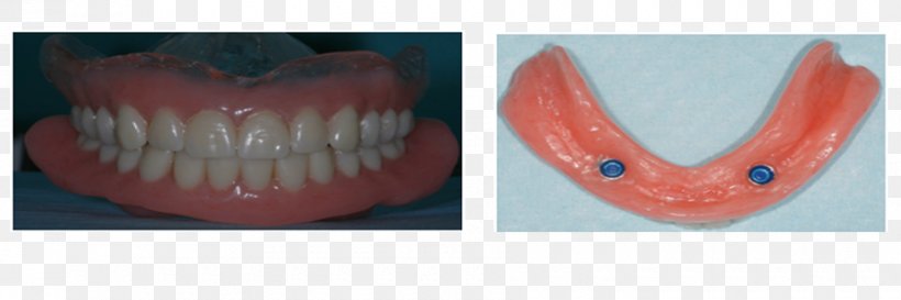 Tooth Dentures, PNG, 900x300px, Tooth, Chin, Dentures, Jaw, Lip Download Free