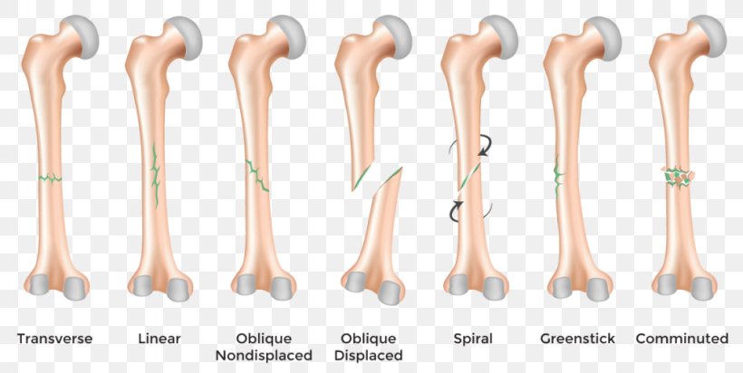 Bone Fracture Bone Healing Greenstick Fracture Injury, PNG, 1024x515px, Bone Fracture, Ankle Fracture, Arm, Bone, Bone Disease Download Free