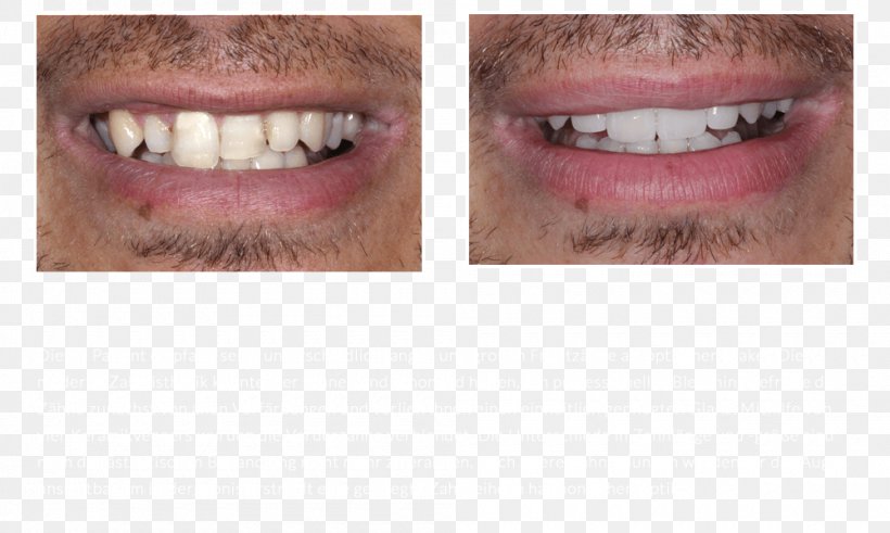 Tooth Whitening Veneer DiPura Bridge, PNG, 1000x600px, Tooth, Aesthetics, Artificial Hair Integrations, Bridge, Ceramic Download Free