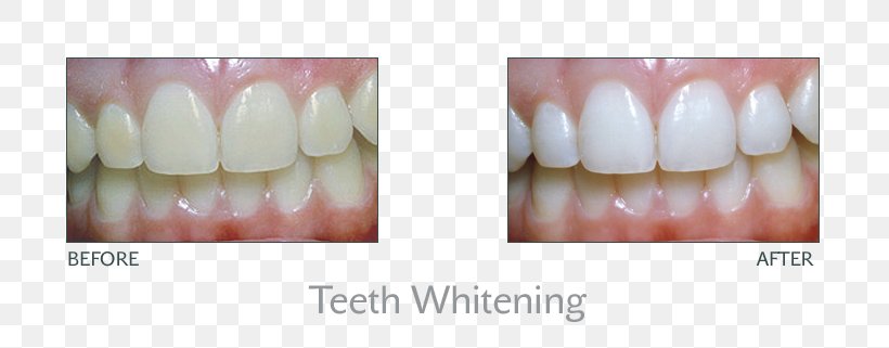 Tooth Whitening Dentistry Human Tooth, PNG, 800x321px, Tooth, Beauty, Chin, Cosmetic Dentistry, Dentist Download Free