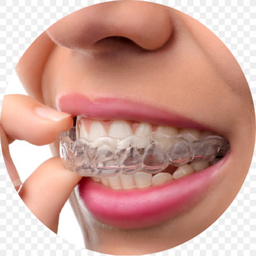 Dental Braces Clear Aligners Orthodontics Cosmetic Dentistry, PNG, 1059x1059px, Dental Braces, Cheek, Chin, Clear Aligners, Close Up Download Free