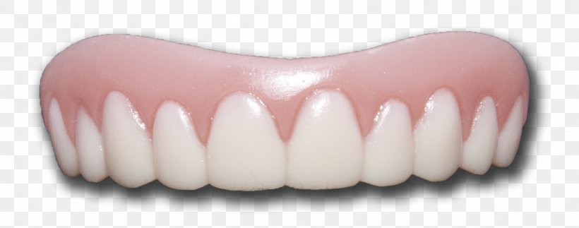 Veneer Tooth Whitening Dentures Tooth Pathology, PNG, 1764x696px, Veneer, Chin, Cosmetic Dentistry, Crest Whitestrips, Dental Technician Download Free