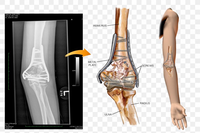 Screw Nail Nut Steel Bone, PNG, 1300x867px, Screw, Arm, Bone, Bone Fracture, Finger Download Free