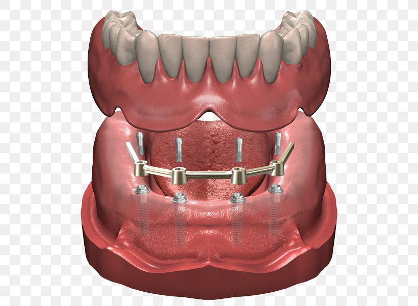 Dentures Dental Implant Prosthesis Dentist, PNG, 600x600px, Watercolor, Cartoon, Flower, Frame, Heart Download Free