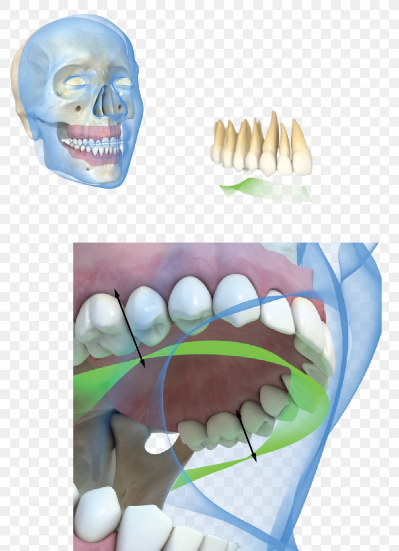 Tooth Dental Implant Occlusion Gums, PNG, 970x1340px, Watercolor, Cartoon, Flower, Frame, Heart Download Free