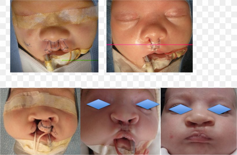 Cleft Lip And Cleft Palate Snout Infant Surgery, PNG, 1477x964px, Cleft Lip And Cleft Palate, Cheek, Chin, Close Up, Ear Download Free