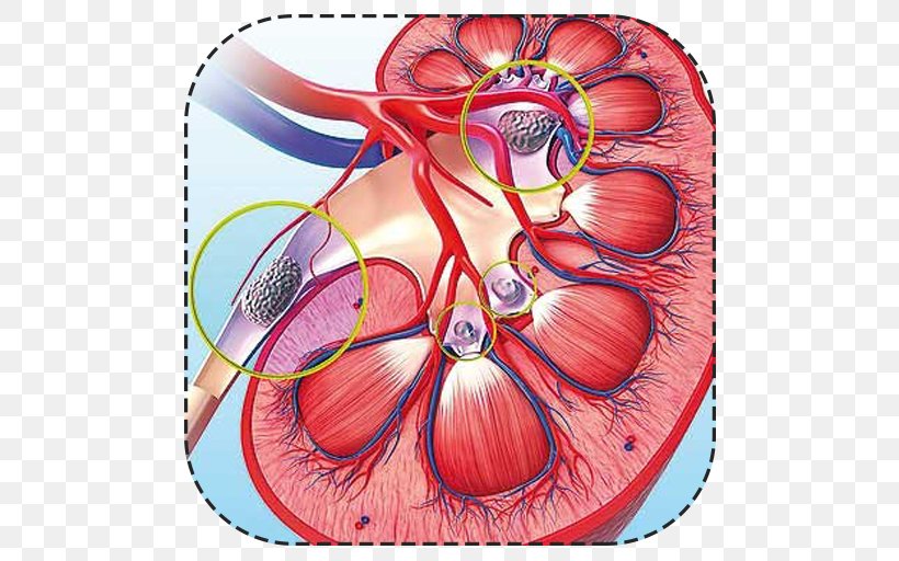 Kidney Stone Urology Kidney Pain Rock, PNG, 512x512px, Watercolor, Cartoon, Flower, Frame, Heart Download Free