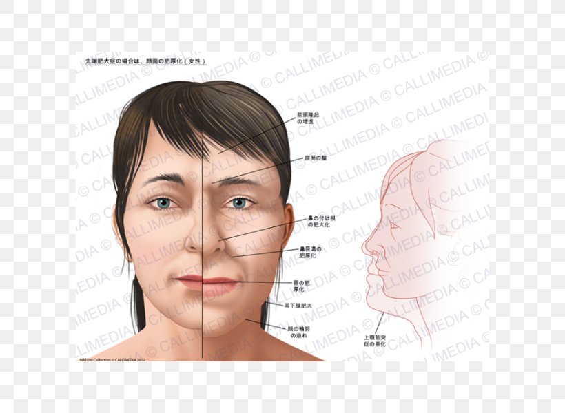 Acromegaly Gigantism Face Growth Hormone, PNG, 600x600px, Watercolor, Cartoon, Flower, Frame, Heart Download Free