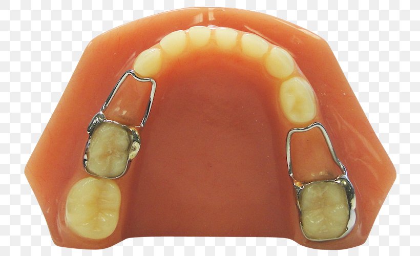 Permanent Teeth Orthodontics Dentistry Deciduous Teeth Tooth, PNG, 728x500px, Permanent Teeth, Clear Aligners, Crown, Deciduous Teeth, Dental Braces Download Free