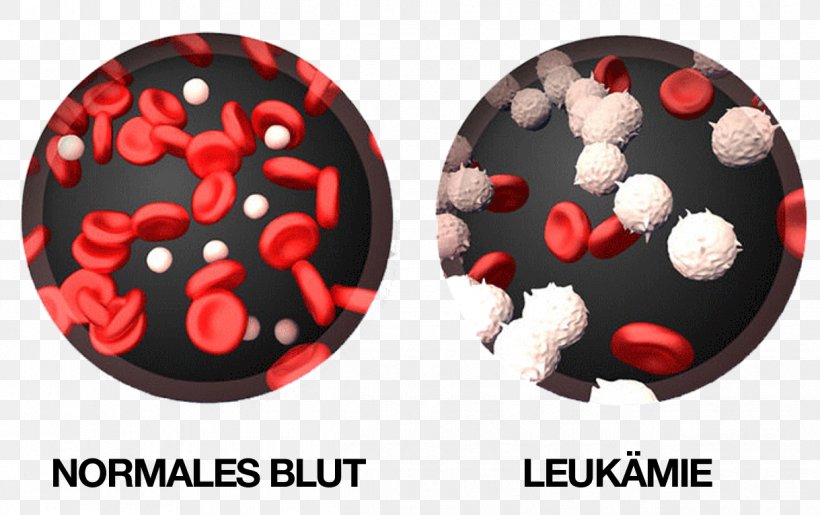 Chronic Myelogenous Leukemia White Blood Cell, PNG, 1219x766px, Leukemia, Acute Lymphoblastic Leukemia, Acute Myeloid Leukemia, Blood, Blood Cell Download Free