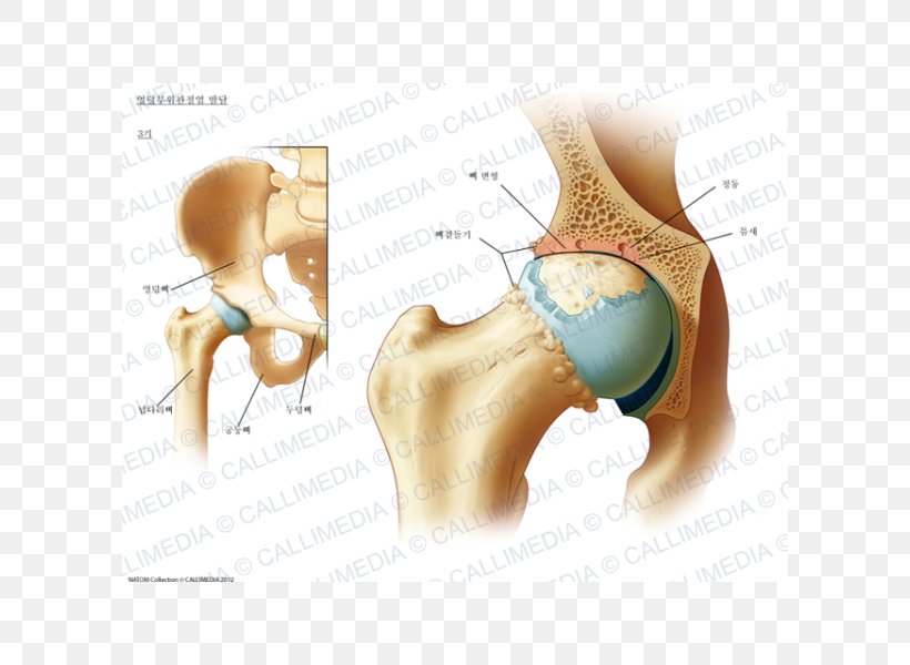 osteoarthritis crueval kezelés kalcaneális bursitis tünetei és kezelése