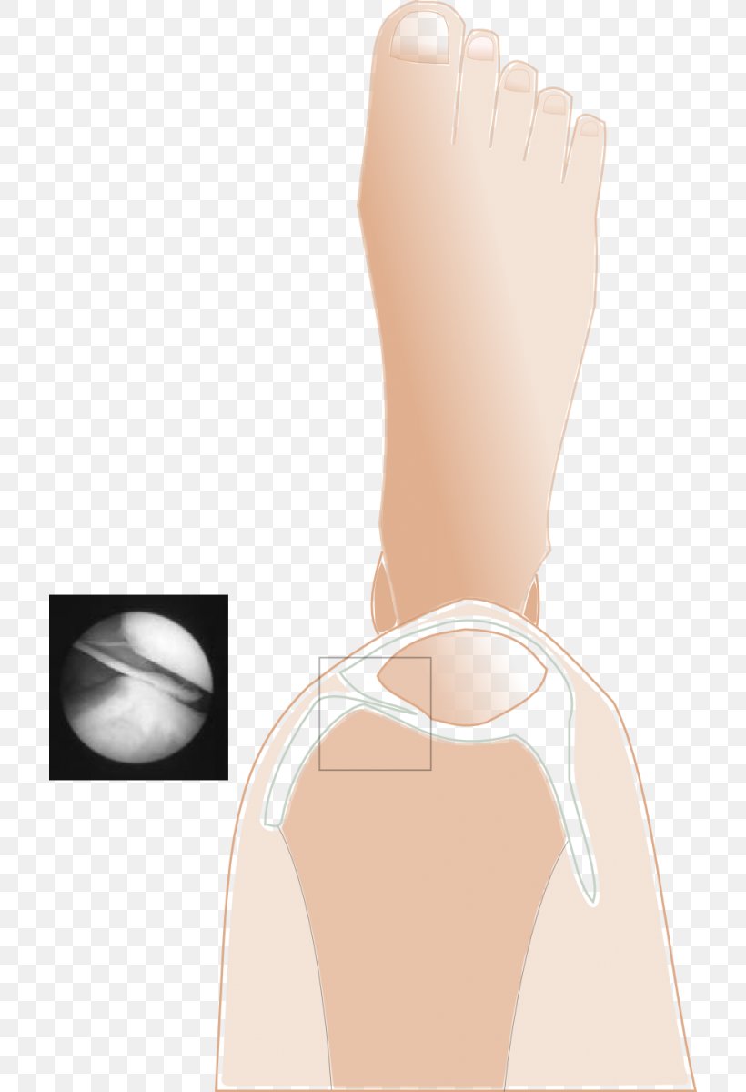 Thumb Plica Syndrome Knee Pain Patella, PNG, 712x1200px, Watercolor, Cartoon, Flower, Frame, Heart Download Free