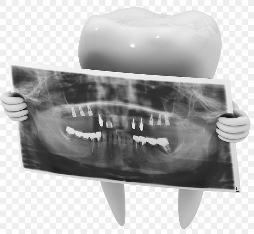 Dental Radiography X-ray Dentistry Tooth, PNG, 1500x1384px, Dentistry, Black And White, Brand, Cone Beam Computed Tomography, Cosmetic Dentistry Download Free