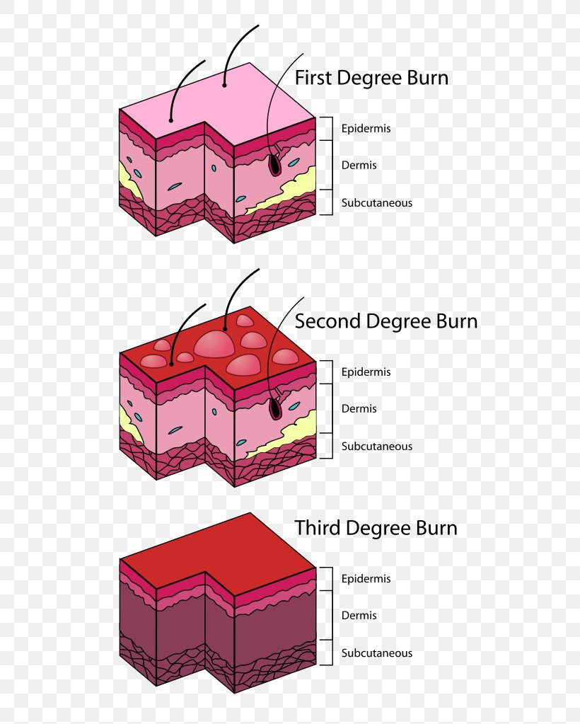 Burn Third Degree Vierdegraads Brandwond Eerstegraads Brandwond Blister, PNG, 597x1023px, Burn, Academic Degree, Ache, Blister, Box Download Free