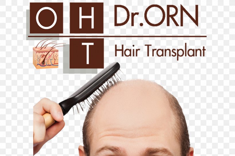 Management Of Hair Loss Hair Transplantation Platelet-rich Plasma Therapy, PNG, 1500x1000px, Hair Loss, Brand, Chin, Clinic, Ear Download Free