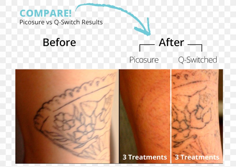 Tattoo Removal Détatouage Laser Q-switching, PNG, 848x602px, Tattoo Removal, Abziehtattoo, Arm, Cosmetics, Dermatology Download Free