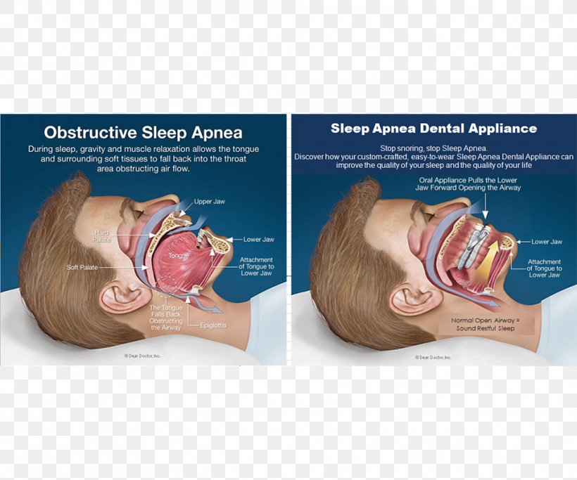 Obstructive Sleep Apnea Continuous Positive Airway Pressure, PNG, 960x800px, Sleep Apnea, Apnea, Bruxism, Continuous Positive Airway Pressure, Dentistry Download Free