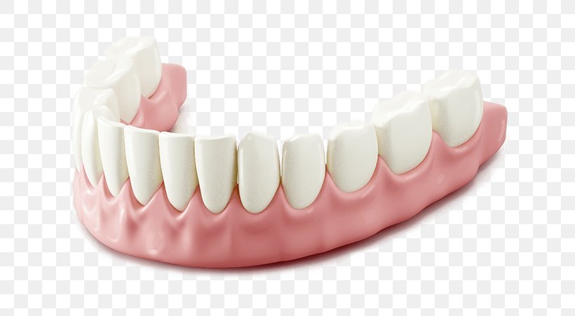 Human Tooth Dentures Dentistry Prosthesis, PNG, 634x451px, Tooth, Bleeding On Probing, Cosmetic Dentistry, Dental Extraction, Dental Implant Download Free