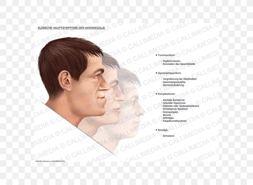 Nose Acromegaly Symptom Pituitary Gland Medical Sign, PNG, 600x600px, Nose, Acromegaly, Arthropathy, Body, Cheek Download Free