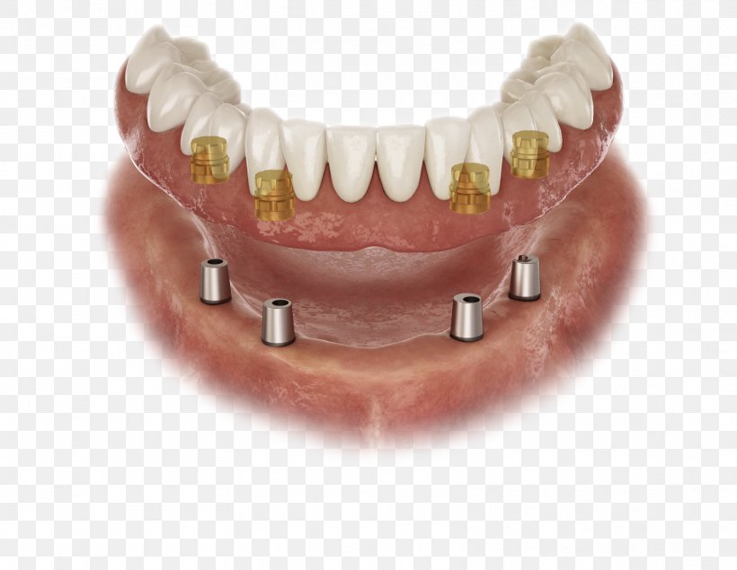 Abutment Dental Implant Prosthesis Dental Laboratory Dentures, PNG, 1666x1292px, Abutment, Bridge, Cadcam Dentistry, Crown, Dental Implant Download Free