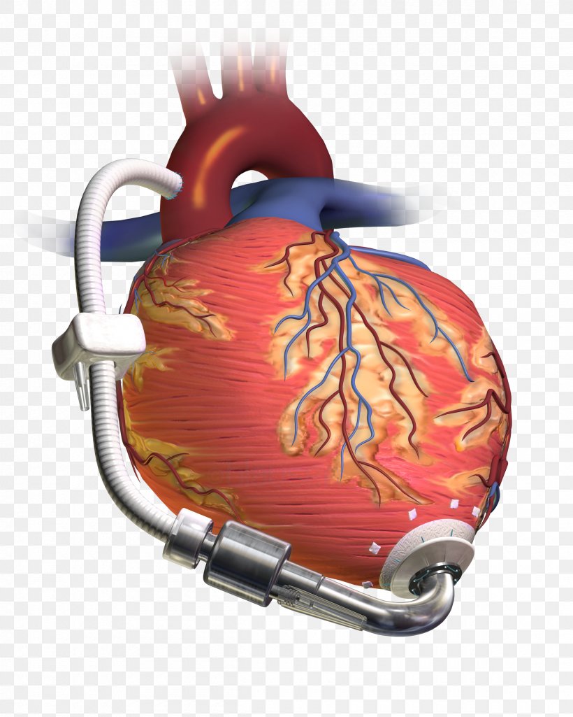 Ventricular Assist Device Heart Transplantation Artificial Heart Ventricle, PNG, 2400x3000px, Watercolor, Cartoon, Flower, Frame, Heart Download Free