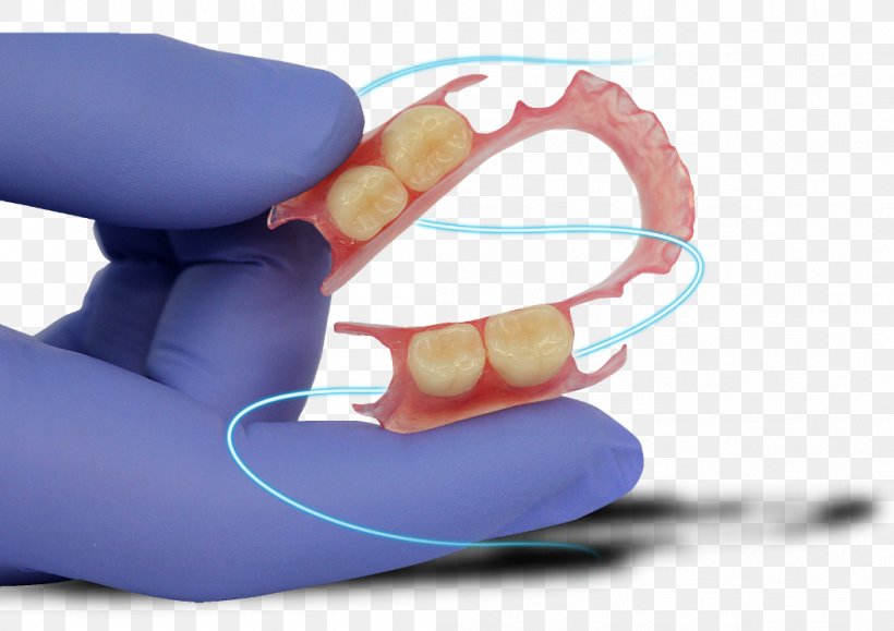 Dentures Prosthesis Dentistry Dental Laboratory, PNG, 1052x744px, Dentures, Cadcam Dentistry, Clinic, Cosmetic Dentistry, Crown Download Free