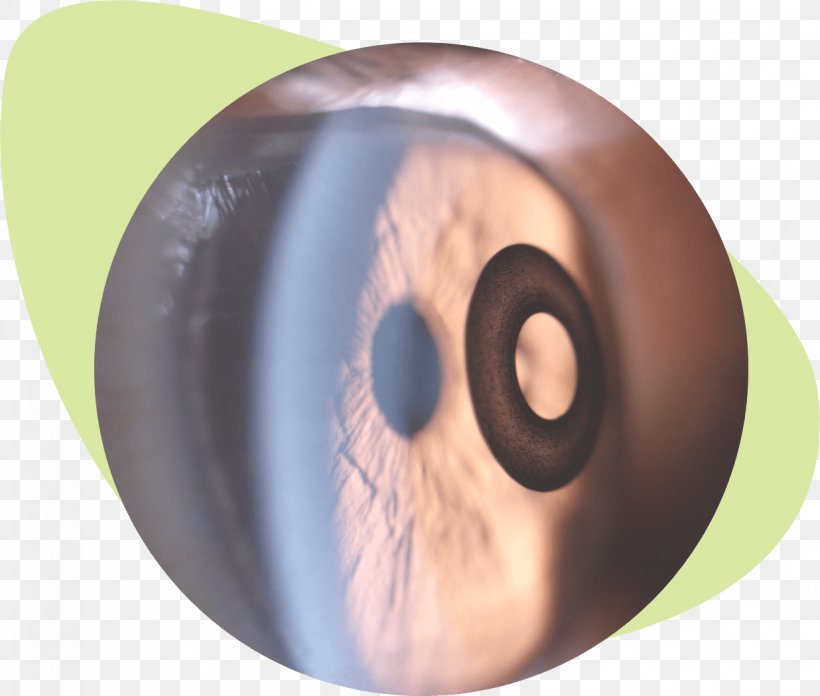 KAMRA-Implantat Corneal Inlay LASIK Presbyopia, PNG, 1236x1050px, Watercolor, Cartoon, Flower, Frame, Heart Download Free