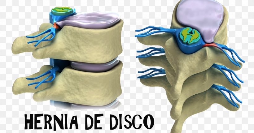 Spinal Disc Herniation Vertebral Column Lumbar Vertebrae Intervertebral Disc Therapy, PNG, 1200x630px, Spinal Disc Herniation, Ache, Injury, Intervertebral Disc, Joint Download Free