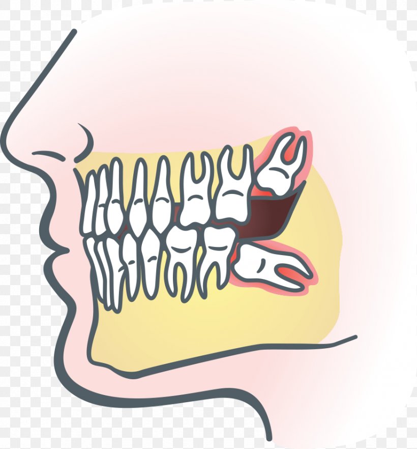 Wisdom Tooth Dental Extraction Impacted Wisdom Teeth Dentistry Tooth Impaction, PNG, 873x940px, Wisdom Tooth, Area, Art, Brand, Cartoon Download Free