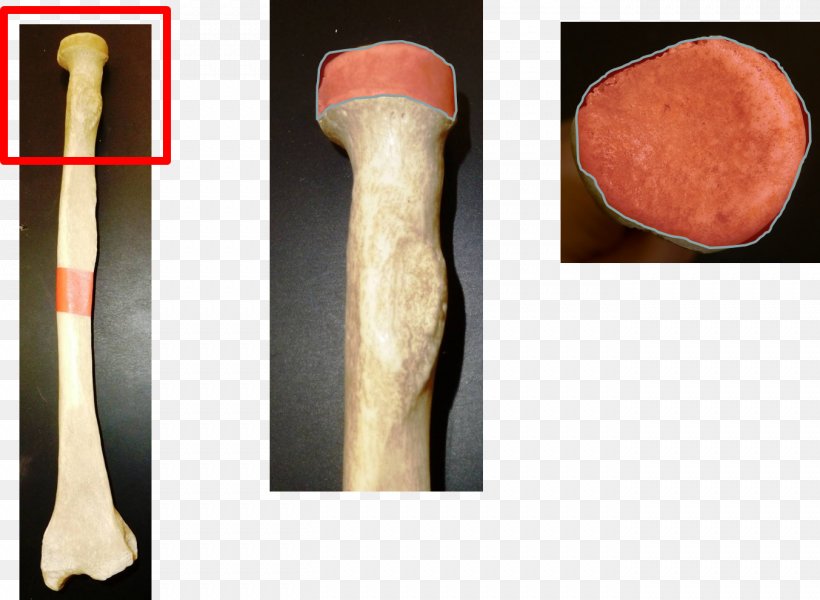 Head Of Radius Radial Head Fracture Radial Tuberosity Bone Fracture, PNG, 1353x990px, Head Of Radius, Anatomy, Arm, Authorstream, Bone Download Free