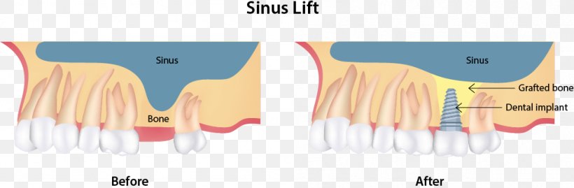 Sinus Lift Dental Implant Dentist Surgery, PNG, 999x328px, Watercolor, Cartoon, Flower, Frame, Heart Download Free